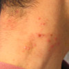 Picture of molluscum bumps 3 days after treatment