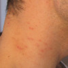 Picture of molluscum bumps 1 week after treatment